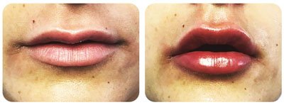 Lip Enhancement